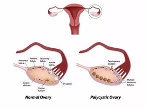 多囊卵巢综合征的治疗指南