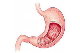 慢性胃炎的主要症状和体征