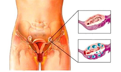 多囊卵巢综合症有治好的案例吗