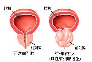 前列腺增生患者的护理