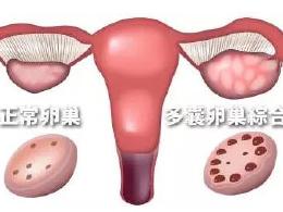 多囊卵巢的治愈案例
